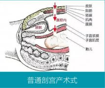 剖宫产就是剖腹产？错啦，有一种剖宫产术式就无需打开腹腔！